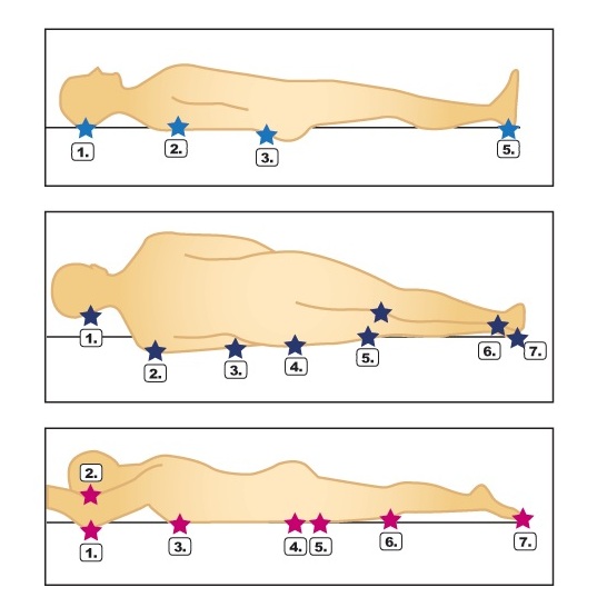 Пролежни: причины развития и стадии пролежневых ран