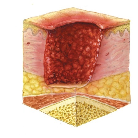 Пролежни На Ногах Фото