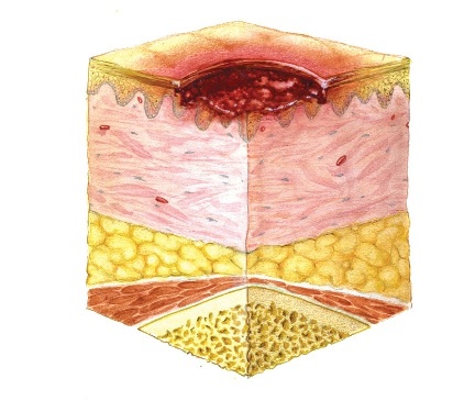 Стадии пролежней